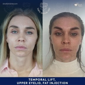 before-after photo facial-fat-transfer