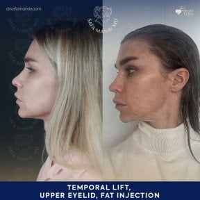 before-after photo facial-fat-transfer