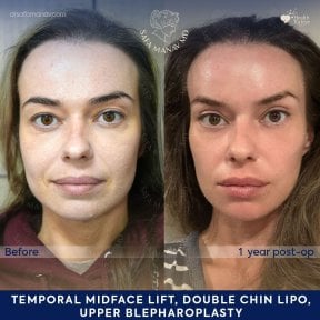 before-after photo facial-fat-transfer