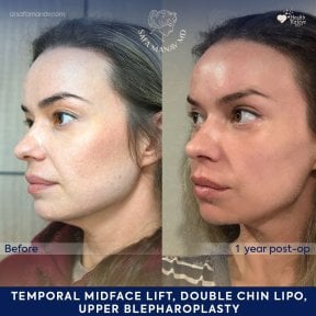 before-after photo facial-fat-transfer