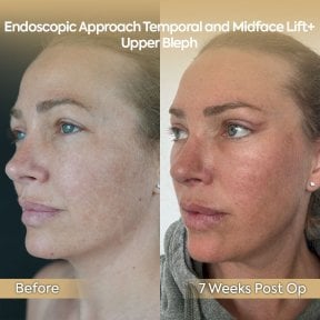 before-after photo facial-fat-transfer
