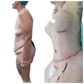 before-after photo abdominoplasty