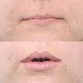 before-after photo lip-lift