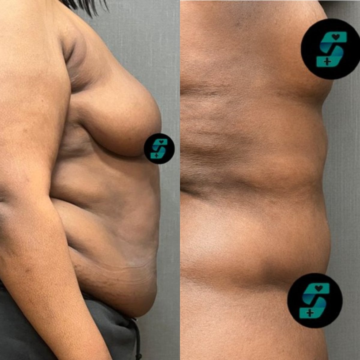 Resultados de abdominoplastia antes y después en Soraca Med – mejora del contorno abdominal