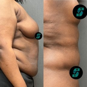 before-after photo abdominoplasty