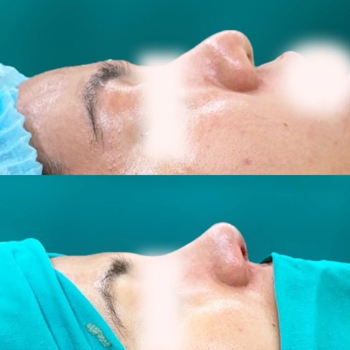 Resultados de rinoplastia antes y después en Munare Clinic Chiangmai, perfil nasal mejorado