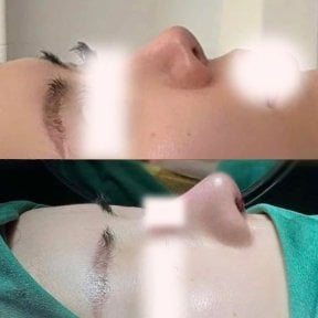 before-after photo rhinoplasty-nose-job