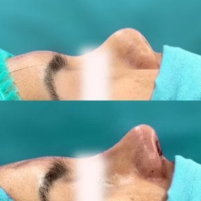 before-after photo rhinoplasty-nose-job