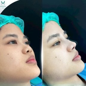 before-after photo rhinoplasty-nose-job