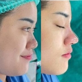before-after photo rhinoplasty-nose-job