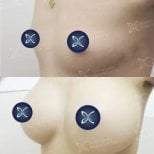 Результати до і після збільшення грудей в Asia Cosmetic Hospital, збільшений об’єм грудей