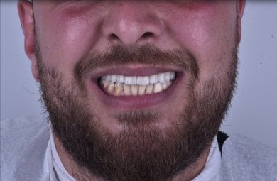 before-after photo dental-implant