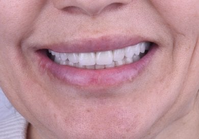 before-after photo dental-implant