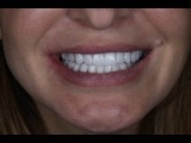 before-after photo dental-implant