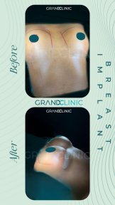 before-after photo mastopexy-breast-lift-contour-plastics
