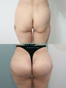 Before and after Brazilian Butt Lift results at Wansiri Hospital, enhanced buttock contour