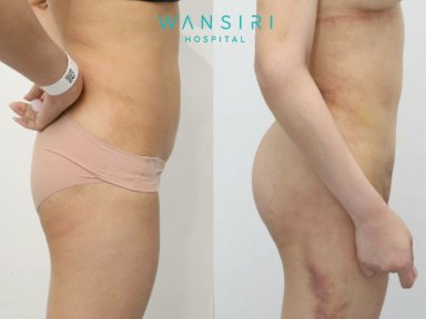 Before and after Brazilian Butt Lift results at Wansiri Hospital, enhanced buttock contour