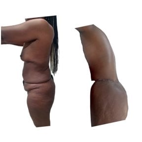 before-after photo post-bariatric-plastic-surgery