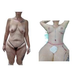before-after photo post-bariatric-plastic-surgery