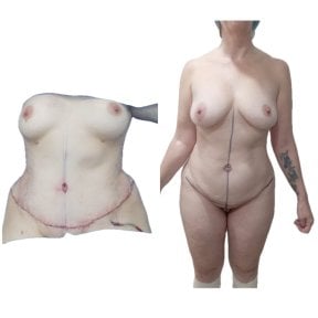 before-after photo post-bariatric-plastic-surgery