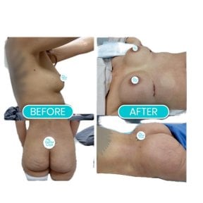 before-after photo post-bariatric-plastic-surgery