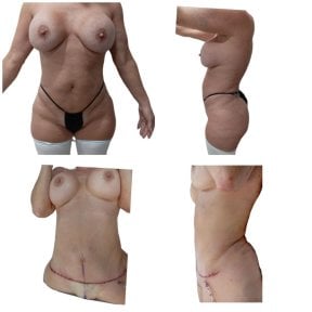 before-after photo abdominoplasty