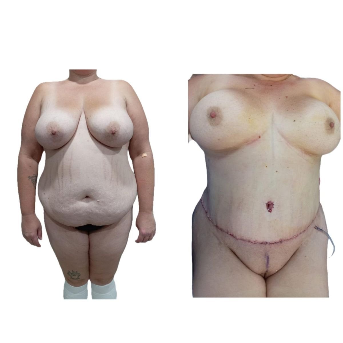 Resultados de abdominoplastia antes y después en Hospital de la Familia, contorno visible