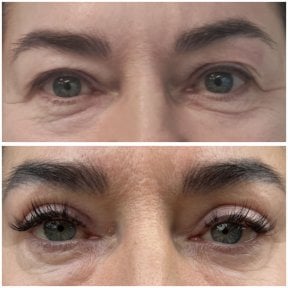 Upper eyelid surgery before and after results at Radzikowska Clinic, rejuvenated eye area