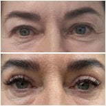 Upper eyelid surgery before and after results at Radzikowska Clinic, rejuvenated eye area