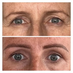 Before and after upper eyelid surgery results at Radzikowska Clinic, rejuvenated eye area