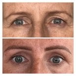 Before and after upper eyelid surgery results at Radzikowska Clinic, rejuvenated eye area