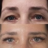Before and after upper eyelid surgery result at Radzikowska Clinic, rejuvenated eye area