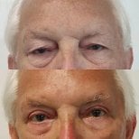 Before and after upper eyelid surgery results at Radzikowska Clinic, improved eye appearance