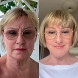 Результаты до и после deep plane facelift в Radzikowska Clinic, омоложение лица