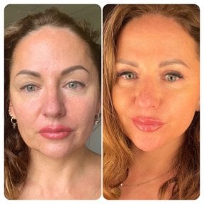 Результаты до и после Deep Plane Facelift в Radzikowska Clinic, омоложение лица