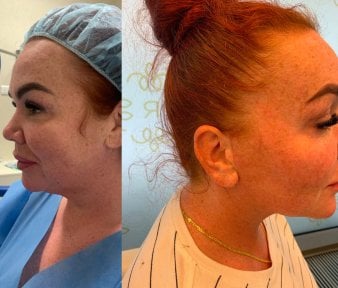 Результаты до и после Deep Plane Facelift в клинике Radzikowska, видимое омоложение лица