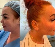 Результаты до и после Deep Plane Facelift в клинике Radzikowska, видимое омоложение лица