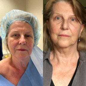 Результаты до и после Deep Plane Facelift в клинике Radzikowska, омоложение лица
