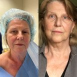 Результаты до и после Deep Plane Facelift в клинике Radzikowska, омоложение лица