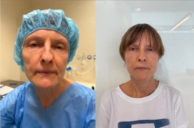 Результаты до и после deep plane подтяжки лица в Radzikowska Clinic, видимое омоложение