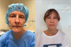 Результаты до и после deep plane подтяжки лица в Radzikowska Clinic, видимое омоложение