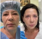 Результаты до и после Deep Plane Facelift в клинике Radzikowska, видимое омоложение лица