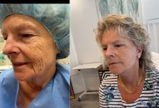 Результат до и после deep plane facelift в Radzikowska Clinic, видимое омоложение лица