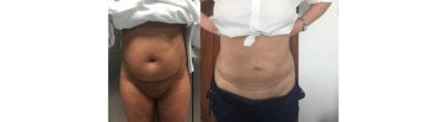 Результаты до и после абдоминопластики и липосакции в Radzikowska Clinic, плоский живот