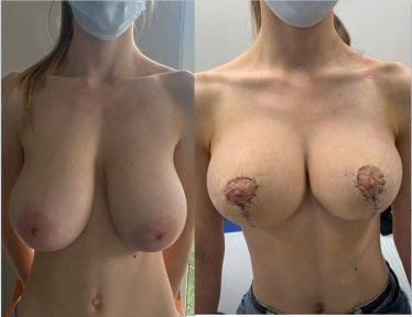 Результаты до и после уменьшения груди в клинике Radzikowska, видимая коррекция формы