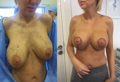 Результаты до и после уменьшения груди в клинике Radzikowska, улучшенная форма груди
