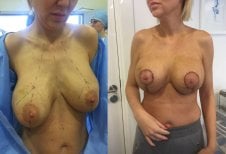 Результаты до и после уменьшения груди в клинике Radzikowska, улучшенная форма груди