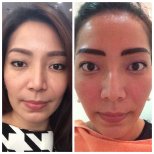 Before and after threads lifting at ASIA CLINIC, facial skin tightening and rejuvenation result