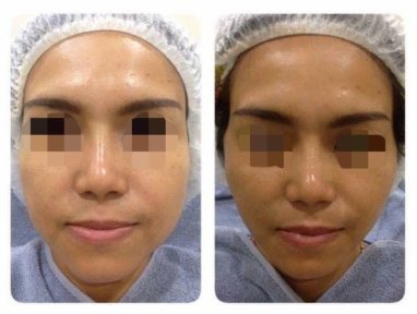 Before and after threads lifting at ASIA CLINIC, facial contour improvement results