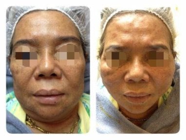 Before and after threads lifting at ASIA CLINIC, facial skin tightening and rejuvenation result